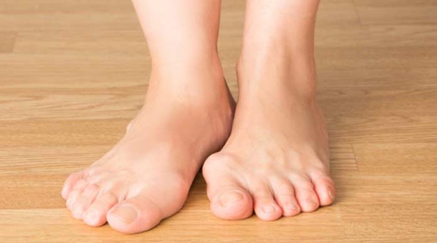 Hallux valgus - minimalno invazivna operacija za korekciju deformacije