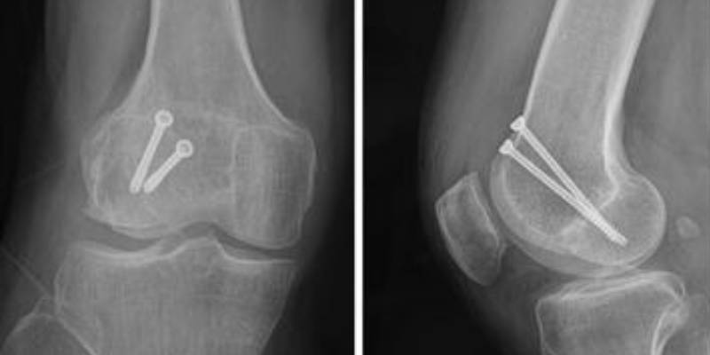 Osteosinteza prijeloma lateralnog kondila femura