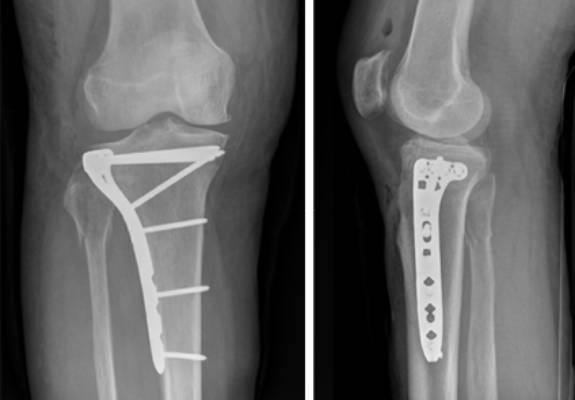 Osteosinteza intraartikularnog prijeloma tibije